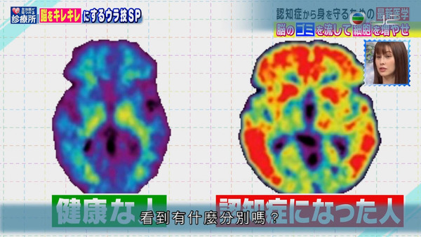 腦部廢物在腦退化症20年前已經開始積聚！　日本醫生教你2招排走腦部廢物／預防認知障礙