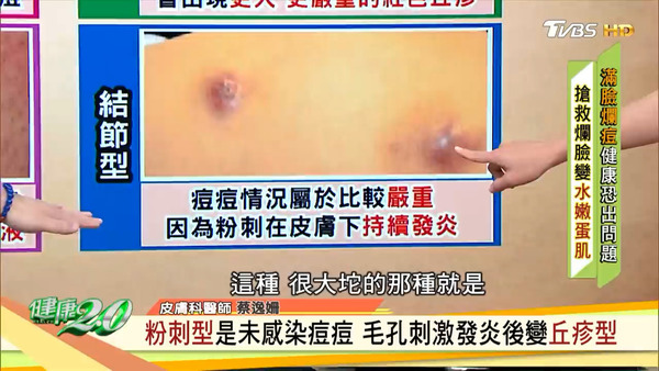 4大暗瘡位置反映身體問題 中醫自製暗瘡膏／天然面膜擊退痘痘