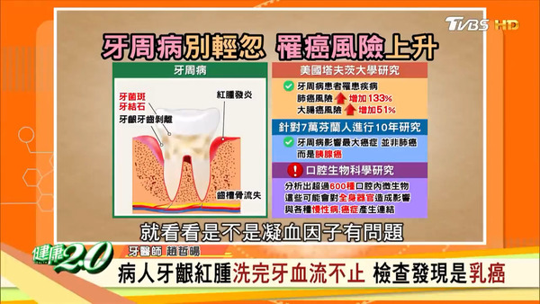 經常流牙血、有鼻鼾恐有牙周病！ 牙周病症狀／牙醫潔齒方法／牙斑菌入血全身遭殃