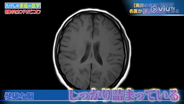 早上起床／飯前最容易病發！　日本節目名醫拆解患上罕見認知障礙症原因