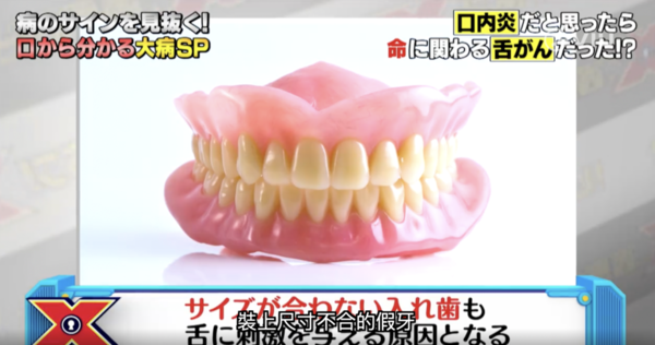 嚴重要切除舌頭！以為生痱滋其實是患癌　日本節目教你正確辨別舌癌／3種人高危