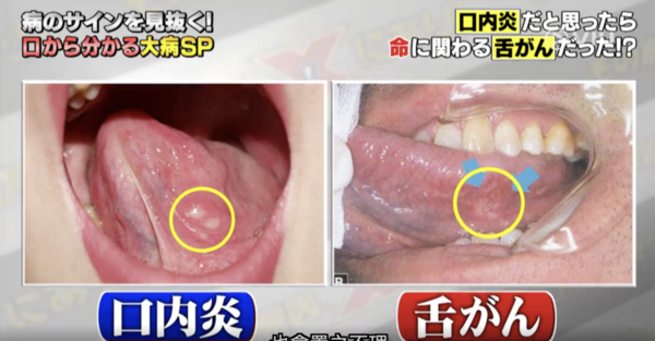 嚴重要切除舌頭！以為生痱滋其實是患癌　日本節目教你正確辨別舌癌／3種人高危
