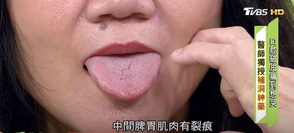 舌頭反映身體狀況 中醫：中間有裂痕／舌苔代表脾胃差