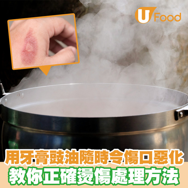 燙傷用牙膏豉油隨時令傷口惡化！ 一文教你正確燙傷處理方法