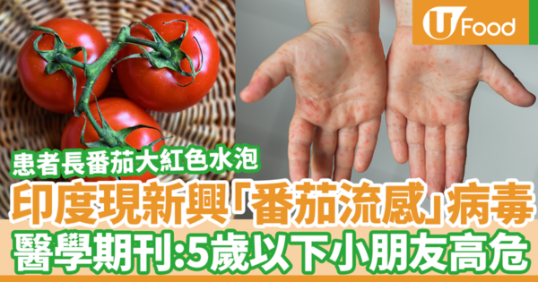 5歲以下兒童高危！印度現新興番茄流感病毒　患者長番茄大紅色水泡／國際醫學期刊：可能是手足口病新變種