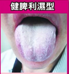 25歲女愛喝珍珠奶茶不愛運動患上嚴重口臭　中醫教你從舌頭情況分辨4種口臭