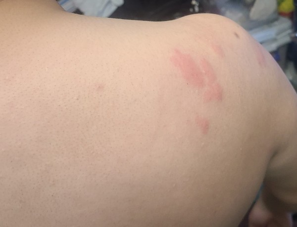 她指男友近半個月手腳和背部都有類似「蚊癩」的紅腫塊。（Facebook圖片）