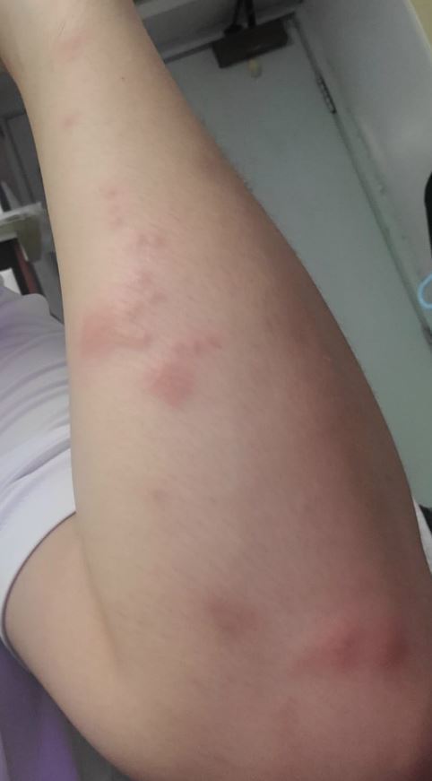 她指男友近半個月手腳和背部都有類似「蚊癩」的紅腫塊。（Facebook圖片）