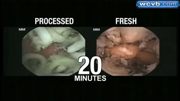 美國醫院拍攝即食麵在胃部消化情況　進食2小時後麵條仍維持原狀