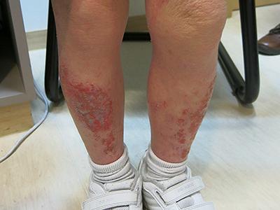 解構濕疹2大成因 皮膚專科醫生教你預防+治療方法
