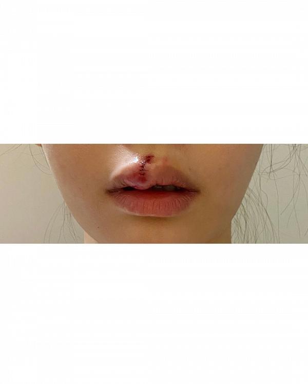 Aka@Super Girls畀狗咬臉隨時有毀容風險 嘴唇縫9針：不敢想像我的嘴還在不在