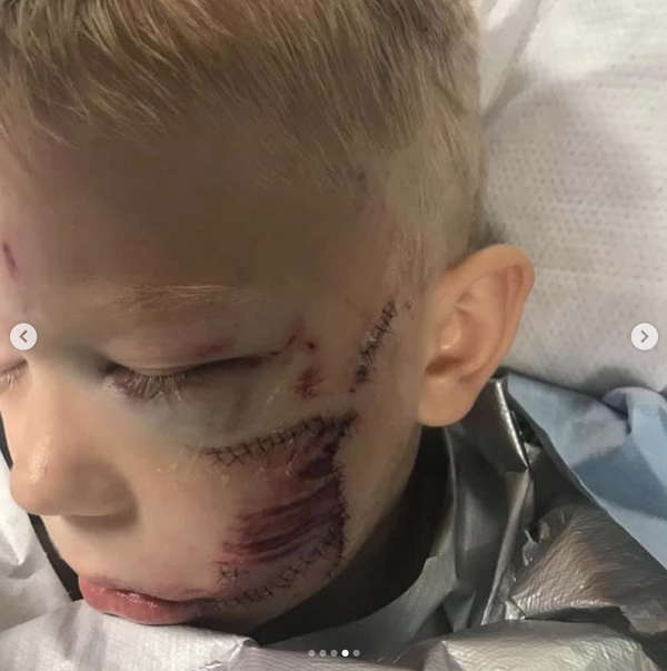 6歲男孩奮勇救妹遭惡犬咬傷縫90針 面部毀容仍不後悔獲美國隊長表揚「真英雄」