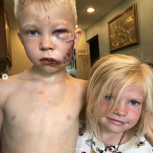 6歲男孩奮勇救妹遭惡犬咬傷縫90針 面部毀容仍不後悔獲美國隊長表揚「真英雄」