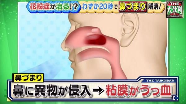 粘膜腫脹後，令吸入空氣的通道變窄，引致鼻塞問題
