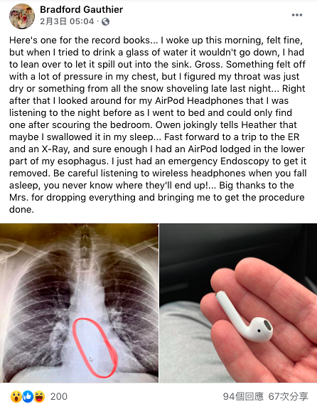 男子戴AirPods睡覺意外吞落肚 耳機卡食道取出後竟然仲用得