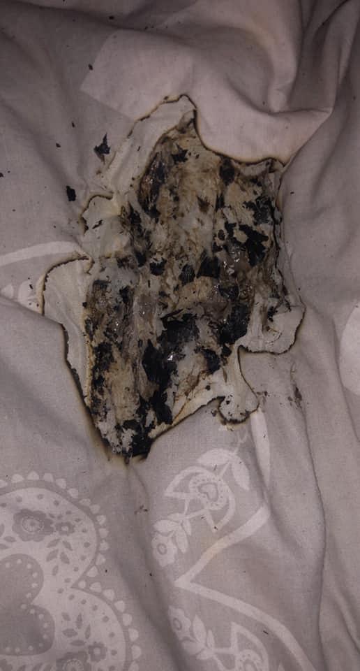 iPhone放床頭充電半夜突然起火 17歲少女面頰燒傷慘被毀容