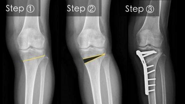 關節退化　要換人工膝嗎？