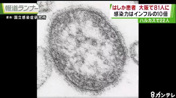 日本麻疹感染人數急升 大阪府患者數目為去年總數5倍