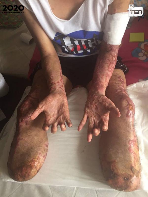 泰國男食豬血受細菌感染 全身嚴重發炎截雙腿保命