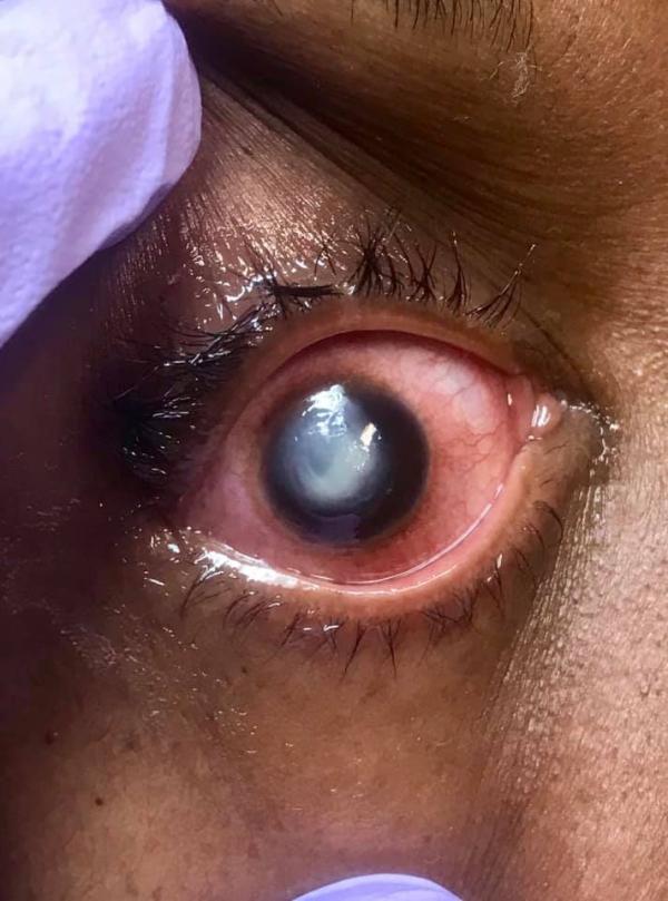戴隱形眼鏡入睡隨時出事！ 醫生警告或惹惡菌侵蝕眼角膜恐失明