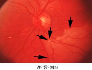 中國旅客到首爾整容失誤致失明 勝訴獲賠償但左眼永久失明！