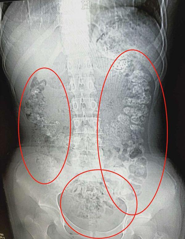14歲少女5天前飲珍珠奶茶後便秘肚痛 檢查後驚見珍珠塞滿腸胃道