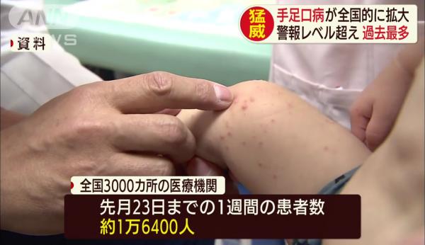 日本手足口病疫情持續