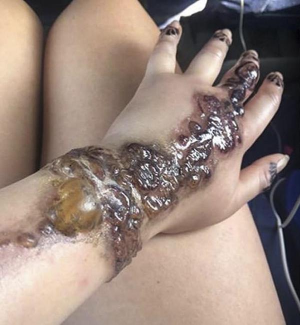 澳洲女旅行玩Henna紋身細菌感染 手冒含膿水泡五指失知覺險截肢
