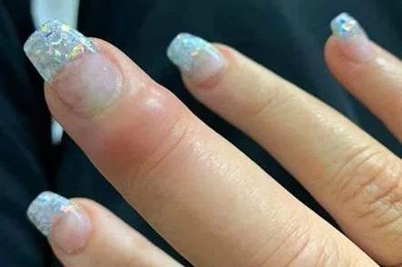 澳洲女美甲後手指染惡菌 整隻手指腫脹發黑流膿