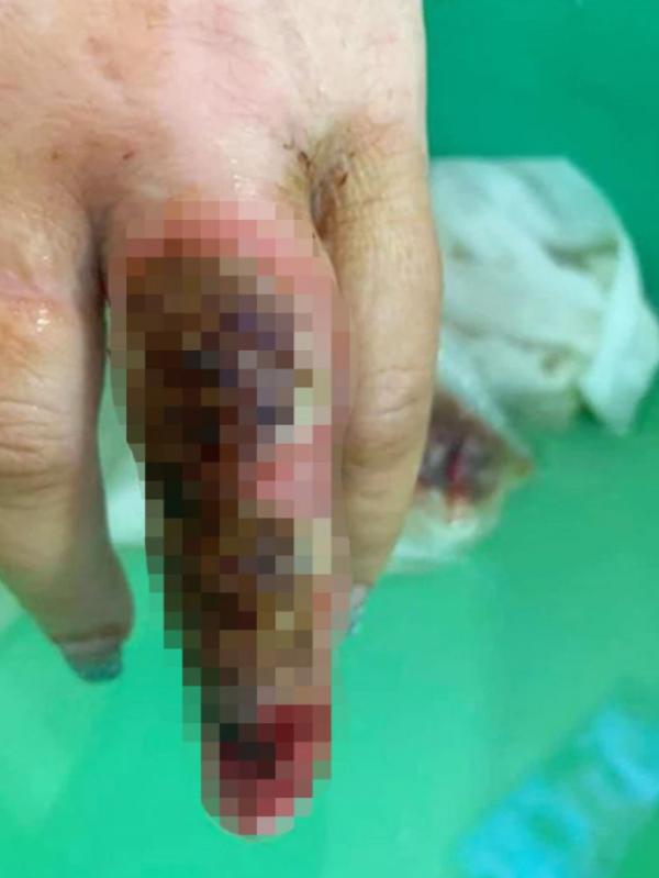 澳洲女美甲後手指染惡菌 整隻手指腫脹發黑流膿