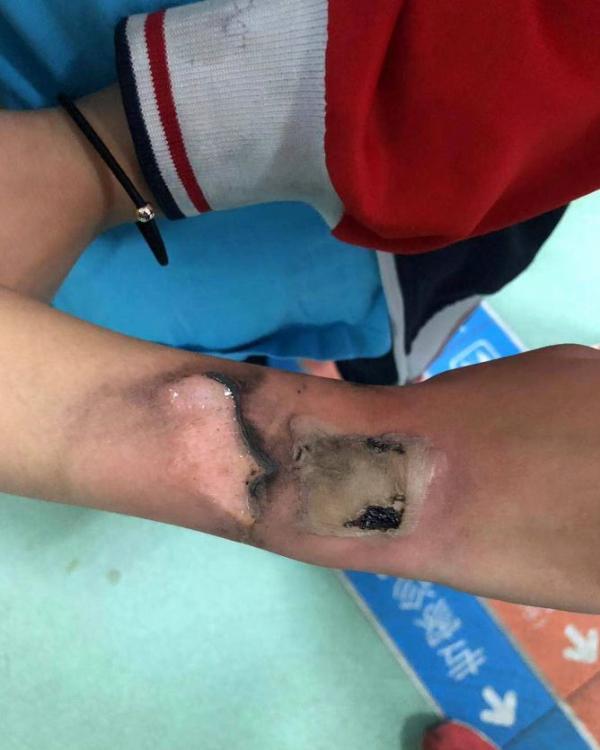 兒童智能手錶發生自燃個案 突飆高溫燙傷手腕！