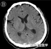 北京醫院證實疫症會併發腦炎 專家：病毒或會攻擊中樞神經系統
