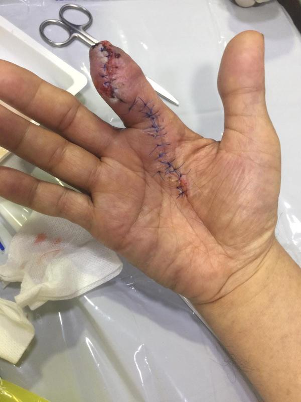 新加坡男洗蝦意外割傷惹食肉菌