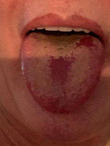 2成患者出現不尋常舌苔 英專家：或為新冠肺炎新病徵