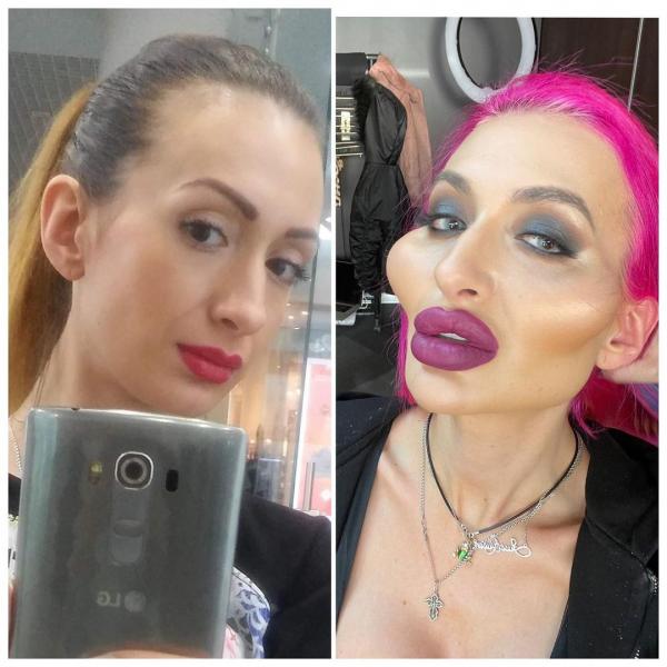 烏克蘭女KOL自稱「世上最大顴骨」 臉頰填充6年仍不滿足 網民：以前更好看