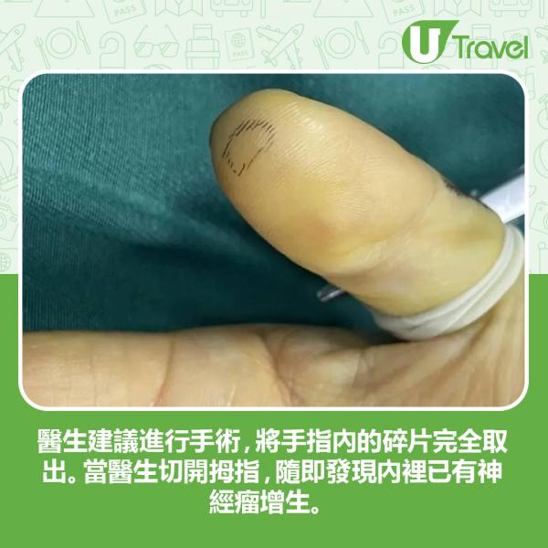 內地女無視手機玻璃貼爆裂 碎片刺傷手指致神經瘤增生需手術切除！