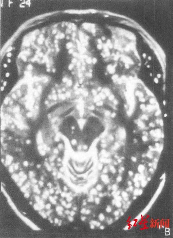 內地男長期頭痛驚驗出腦內寄生蟲多如「芝麻餅」 揭因吃一類食品成恐怖傳染途徑