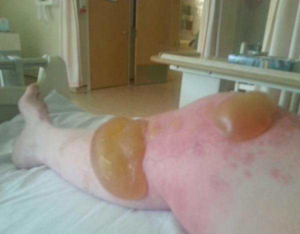 英國夏季現最危險植物大豬草盛開 含劇毒一碰皮膚灼傷起巨型水泡