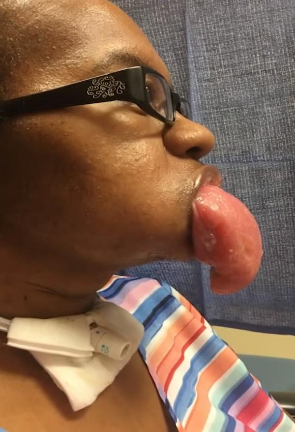 美國多名新冠肺炎康復者患巨舌症 舌頭腫脹數倍無法進食說話