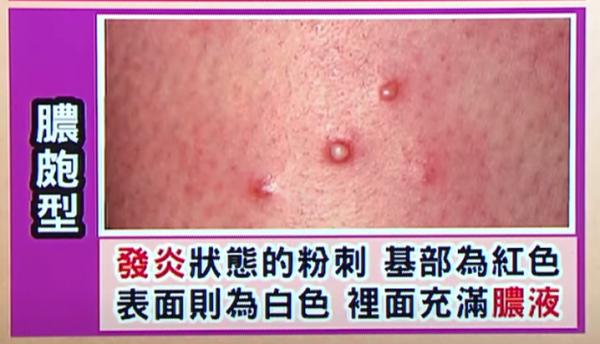 4大部位生暗瘡代表身體有事！ 台灣節目揭示內臟危險訊號