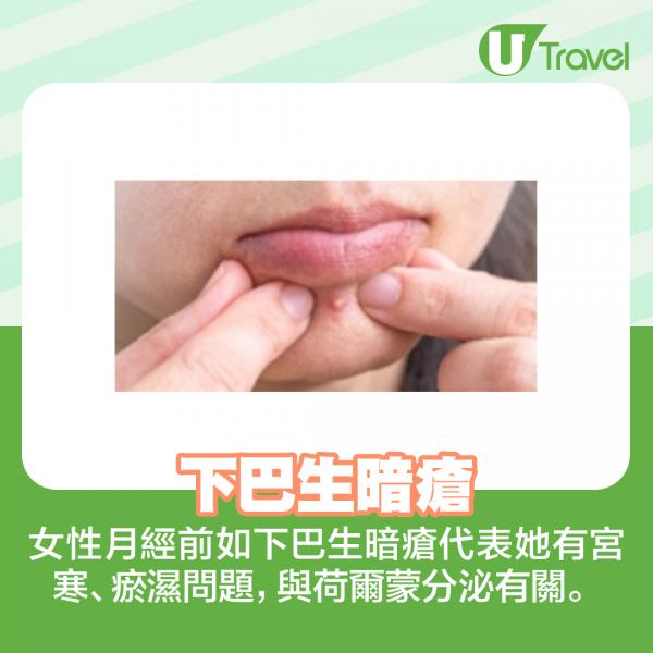 下巴生暗瘡  女性月經前如下巴生暗瘡代表她有宮寒、瘀濕問題，與荷爾蒙分泌有關。