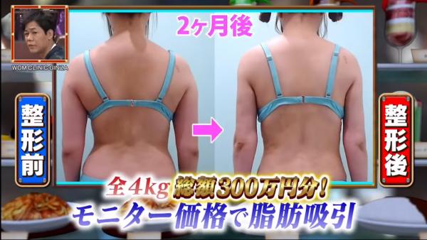 日本女偶像全身整容擲300萬円抽脂 上節目揭辛酸過程：痛到坐唔到廁所