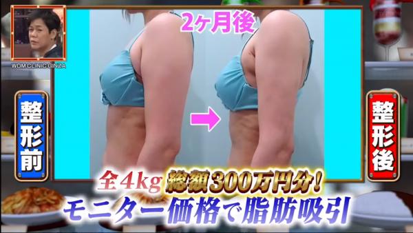 日本女偶像全身整容擲300萬円抽脂 上節目揭辛酸過程：痛到坐唔到廁所