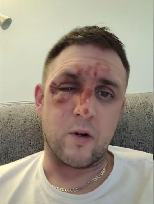 英國男微波爐叮蛋40秒險盲 湯匙舀起即爆炸眼面嚴重燙傷