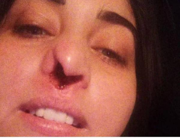 阿根廷女子接受檢測驗後感染 醫療失誤致毀容慘剩1鼻孔