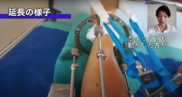 167cm日本醫生花33萬做「骨骼延長手術」 忍痛斷骨增高10cm圓夢變型男！