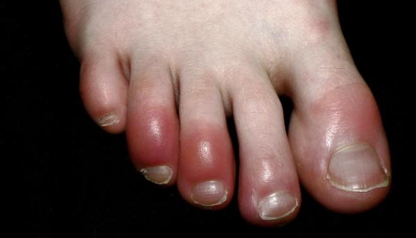 疫情下趾頭紅腫個案急升 研究指出「新冠腳趾」最有可能成因
