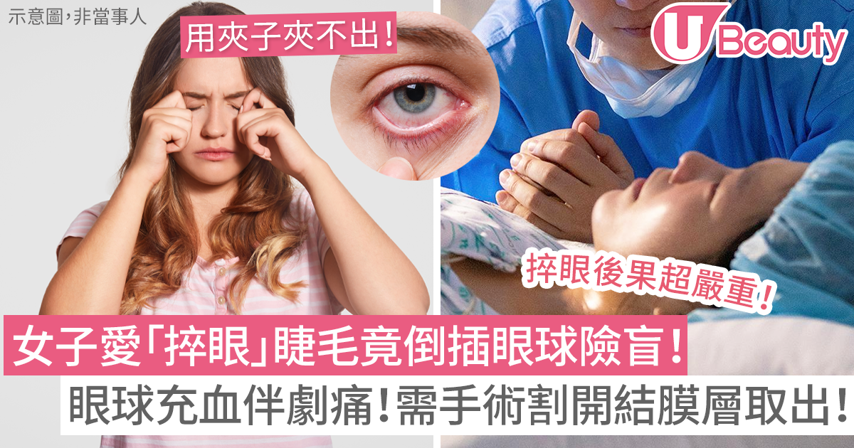 女子愛捽眼睫毛竟倒插眼球險盲!眼球充血伴劇痛!需手術割開結膜層取出! | U Beauty