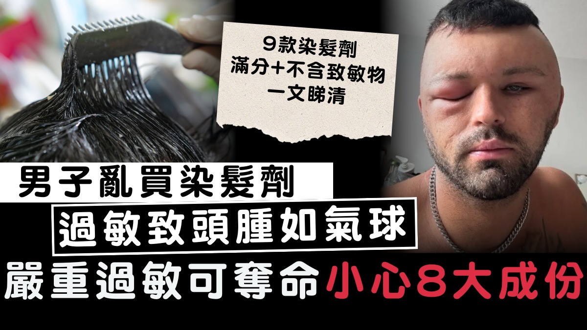 染髮過敏｜男子亂買染髮劑過敏致頭腫如氣球 嚴重過敏可奪命小心8大成份【附26款染髮劑評測】