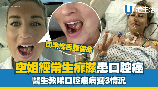 空姐生痱滋患口腔癌切半舌頭保命！醫生教睇口腔癌病變3情況【附口瘡滅火茶食譜】